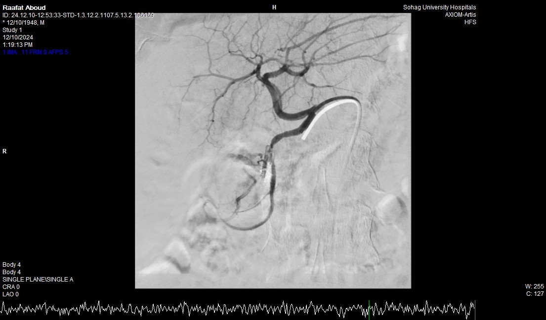 إنقاذ حياة مريض سبعيني بنجاح عبر تدخل طبي متكامل بمستشفى جامعة سوهاج