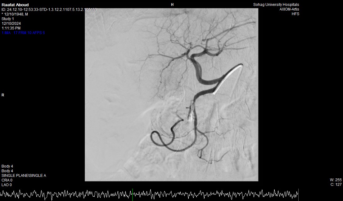 إنقاذ حياة مريض سبعيني بنجاح عبر تدخل طبي متكامل بمستشفى جامعة سوهاج