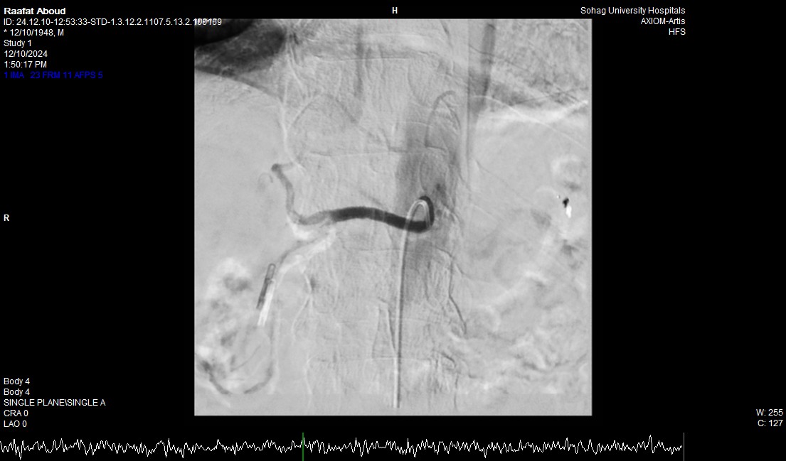 إنقاذ حياة مريض سبعيني بنجاح عبر تدخل طبي متكامل بمستشفى جامعة سوهاج