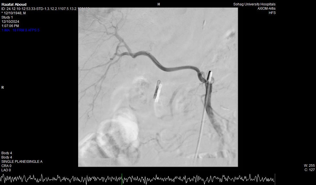 إنقاذ حياة مريض سبعيني بنجاح عبر تدخل طبي متكامل بمستشفى جامعة سوهاج