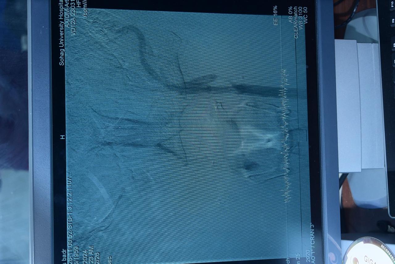 جامعة سوهاج تحقق إنجازًا طبيًا جديدًا وتطلق وحدة القسطرة المخية لخدمة الصعيد