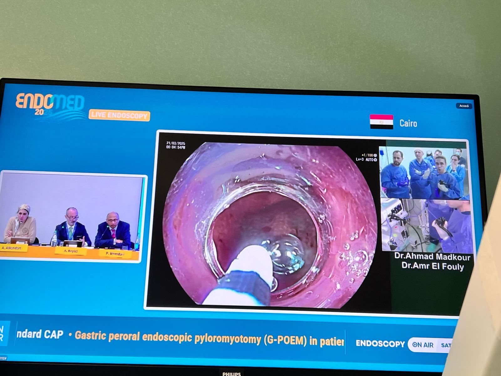 جامعة حلوان تحقق إنجازًا طبيًا عالميًا وإشادة دولية لبث حي لجراحة نادرة بالمنظار 