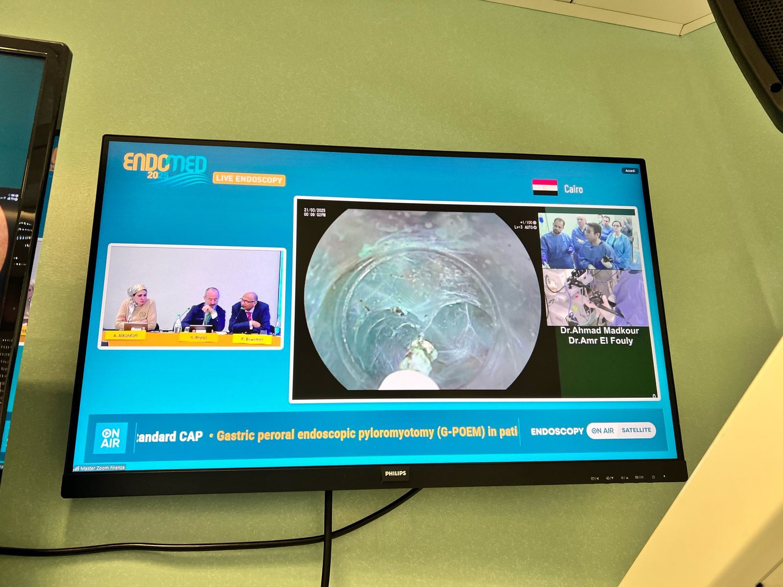 جامعة حلوان تحقق إنجازًا طبيًا عالميًا وإشادة دولية لبث حي لجراحة نادرة بالمنظار 