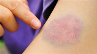 ازاي تتخلص من مشاكل الكدمات بكل سهولة؟.. استخدمي حيل منزلية