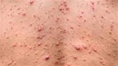  المصل واللقاح: جدري القردة لن يتحول لوباء عالمي لكن وفياته عالية