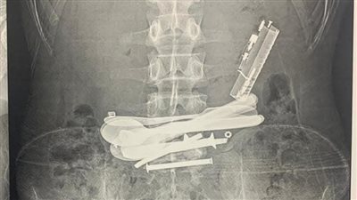 ولاعات ومقصات وسبح.. إنقاذ مريض ابتلع أجسامًا معدنية بمستشفى سوهاج الجامعي