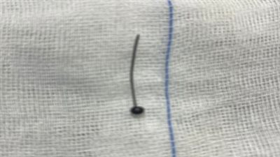 فريق طبي بـ مستشفى سوهاج الجامعي ينجح في استخراج دبوس من معدة طفل 