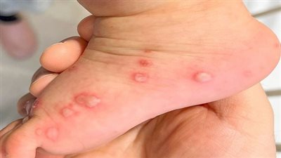 الصحة تكشف عن رأيها في غلق المدارس بعد ظهور حالات إصابة بفيروس مرض اليد والقدم والفم HFMD