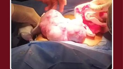 استئصال ورم خبيث يزن 2 كجم من طفلة في جراحة دقيقة استغرقت ساعتين بجامعة طنطا